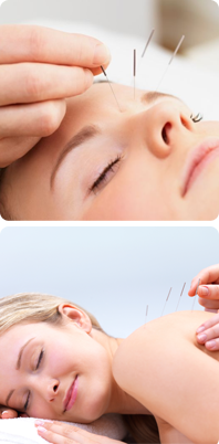 Acupuncture in Barnet